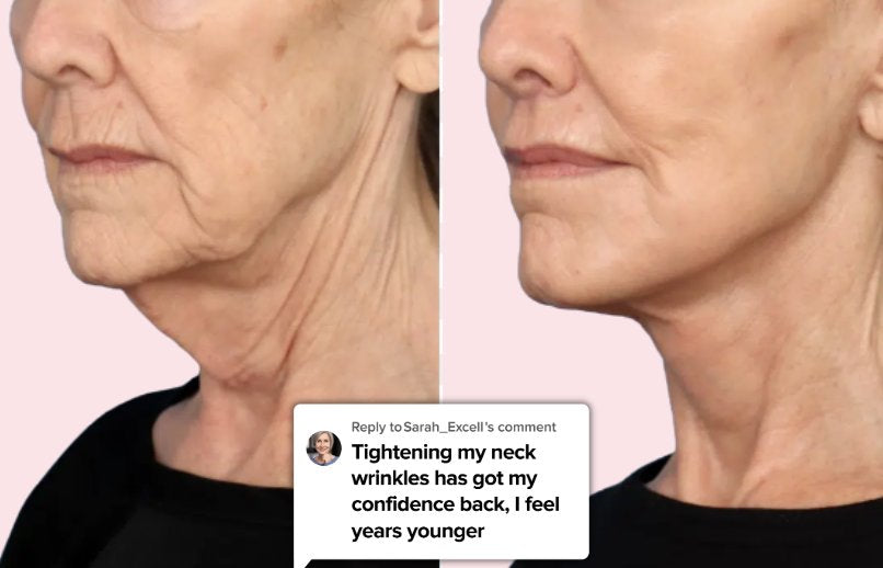 Customer before and after of her neck and jawline, replying to a comment: Tightening my neck wrinkles has got my confidence back, I feel years younger